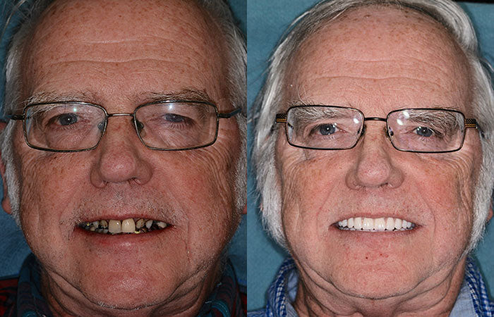 HZA-Advanced Customized Full Denture Set