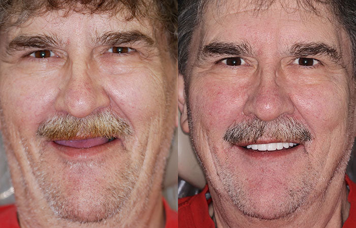 HZA-Advanced Customized Full Denture Set