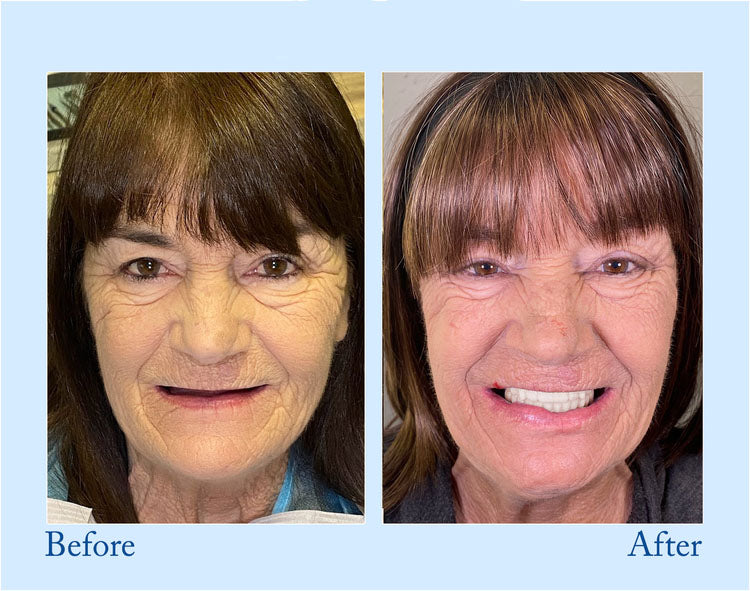 Orthorun | Smileasego - Premium Denture