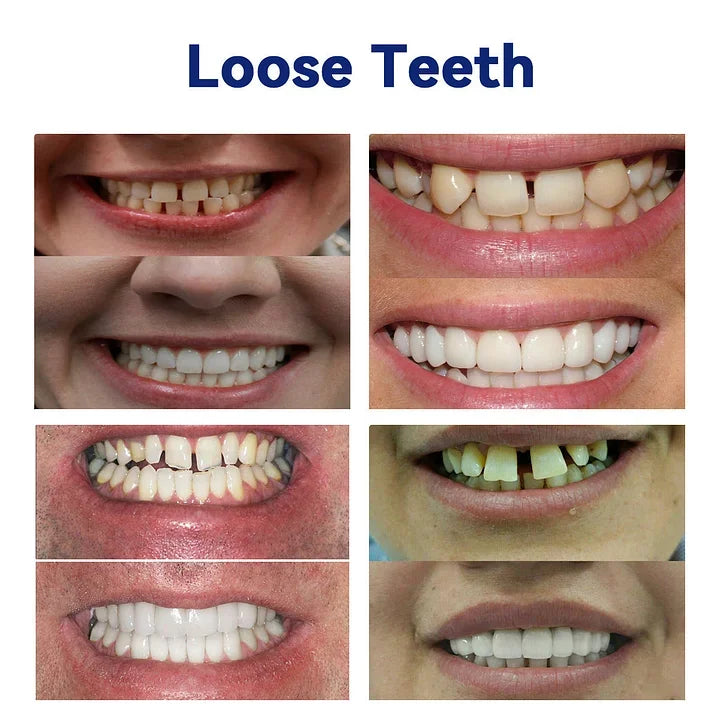 Orthorun | SmileFitPro-New Generation Flexible Full Denture Solution