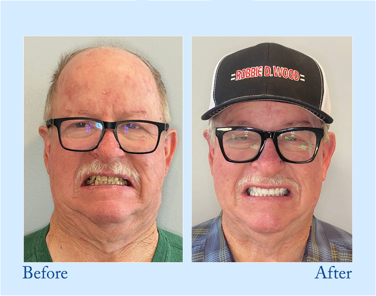 Orthorun | Smileasego - Premium Denture