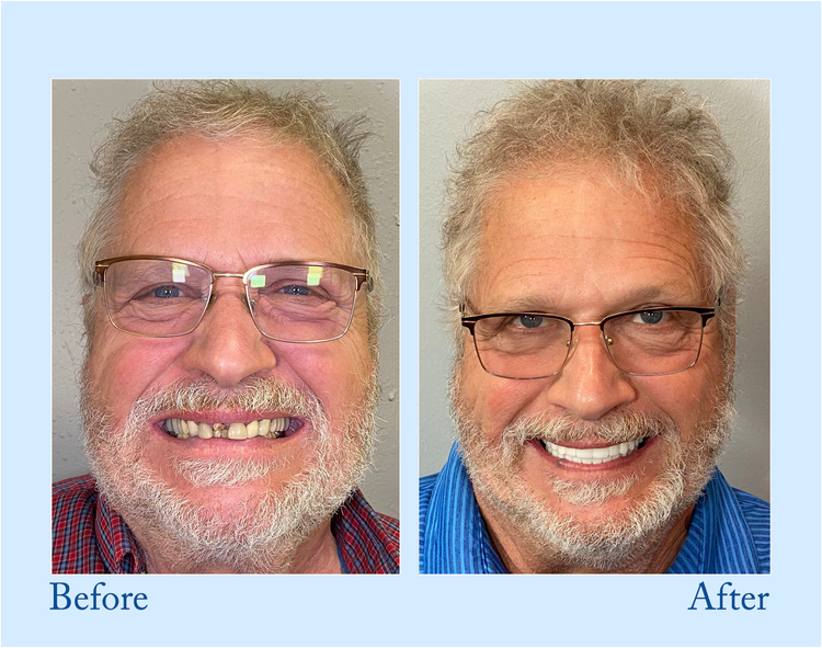 Smileasego™ - Premium Denture