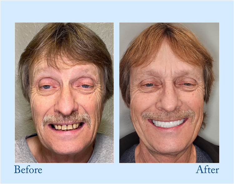 Orthorun | Smileasego - Premium Denture