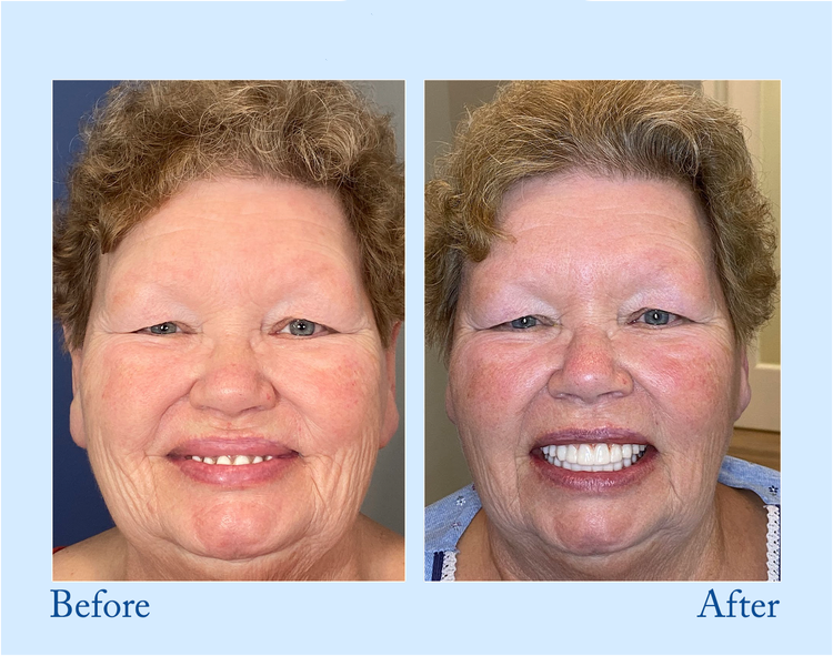 Orthorun | Smileasego - Premium Denture