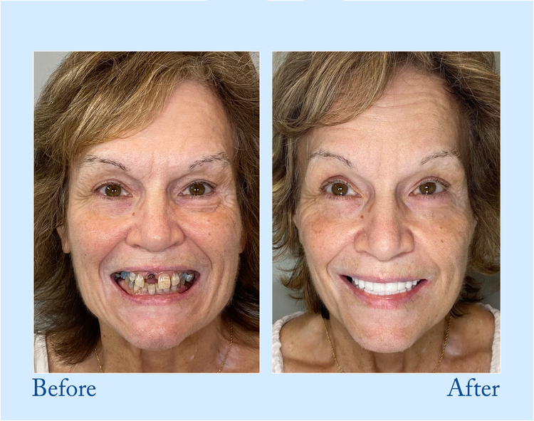 Orthorun | Smileasego - Premium Denture