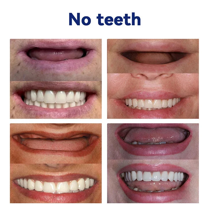 Orthorun | SmileFitPro-New Generation Flexible Full Denture Solution
