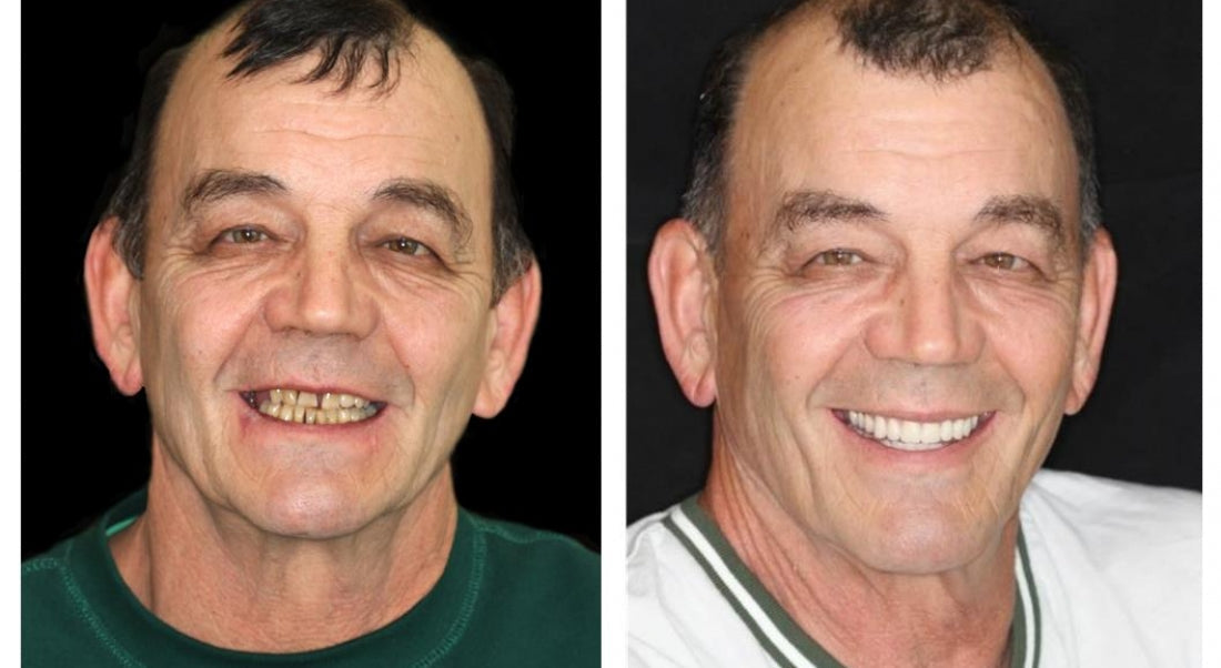 HZA-Advanced Customized Full Denture Set
