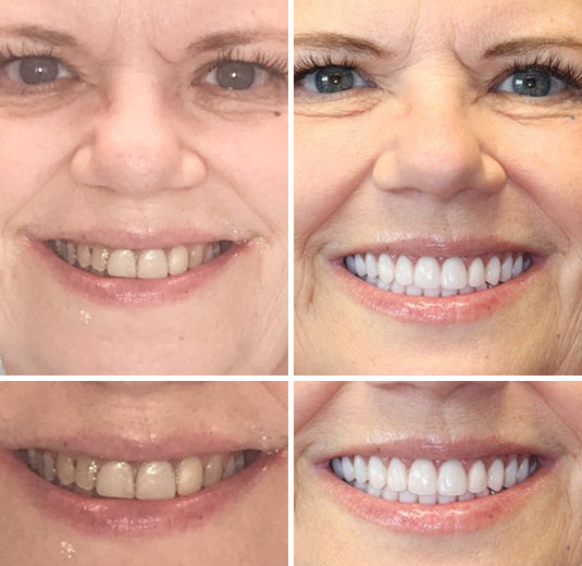 HZA-Advanced Customized Full Denture Set