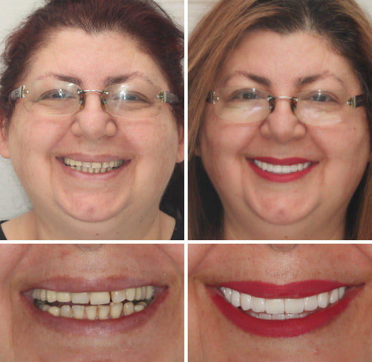 HZA-Advanced Customized Full Denture Set