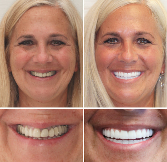 HZA-Advanced Customized Full Denture Set